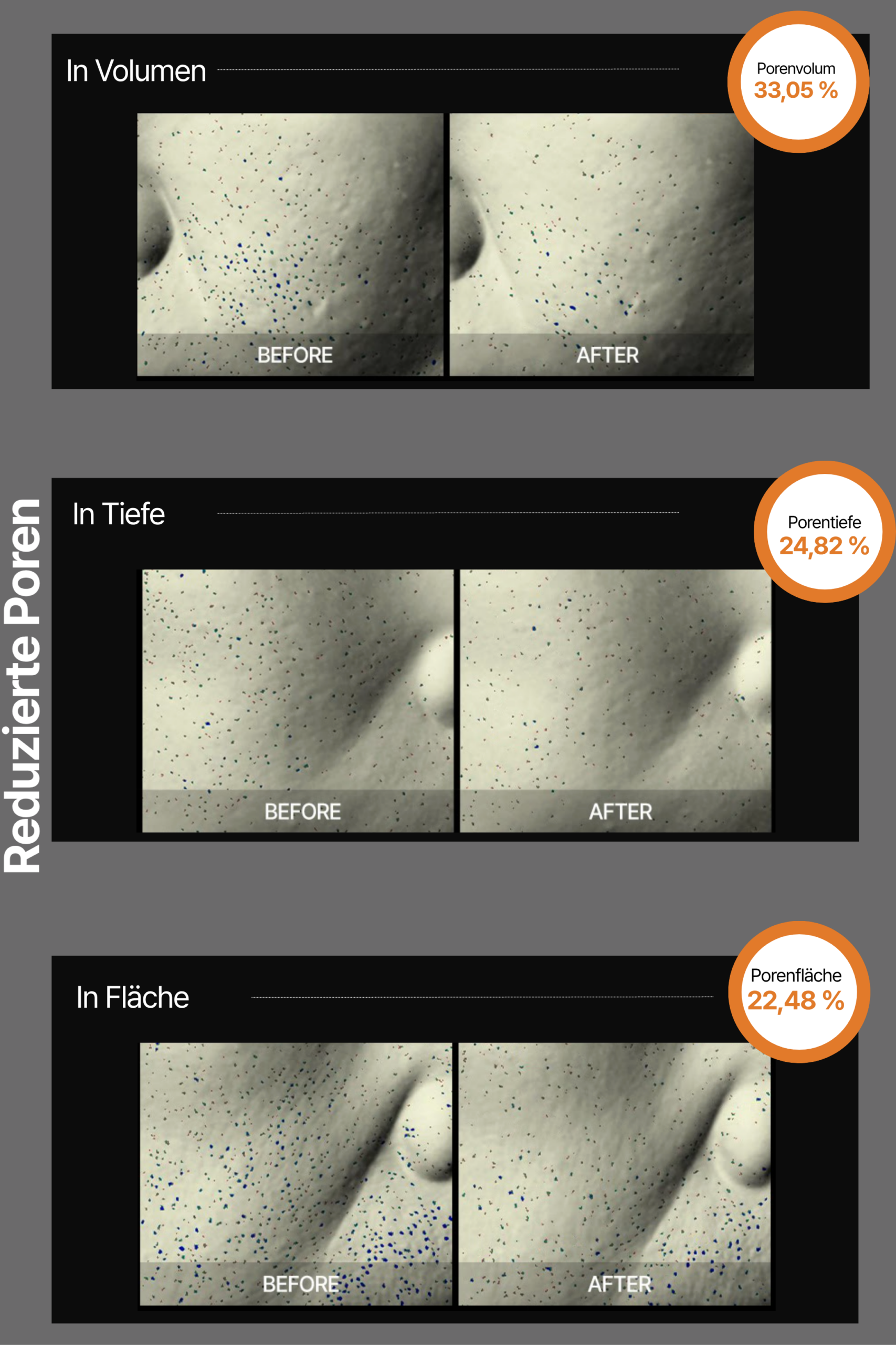 Dermathod Lifting Hydro Veil Mask Porenverfeinerung Vorher-Nachher-Darstellung reduzierter Poren durch die Dermathod Lifting Hydro Veil Mask